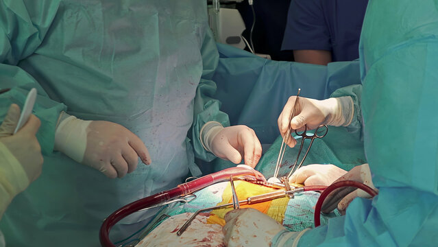 Surgeons Performing Operation in Hospital Room. Medical team in sterile gowns performing surgery with instruments, bright operating light, and blood drainage during a hospital procedure.