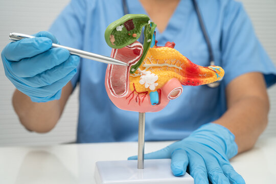 Pancreatitis, pancreatic cancer, Asian doctor with pancreas, gallbladder and bile duct human anatomy model at hospital.