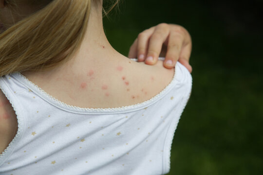 Red, swollen and itchy spots on skin caused by insect bites or allergy. Skin reaction to insect bites. 