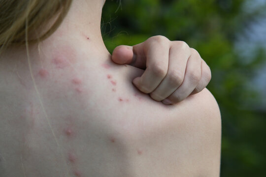 Red, swollen and itchy spots on skin caused by insect bites or allergy. Skin reaction to insect bites. 