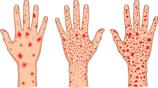 Medical Illustration Set of Human Hands with Red Rashes and Lesions Representing Monkeypox, Measles, or Allergic Reactions for Healthcare Education, Dermatology, and Disease Awareness