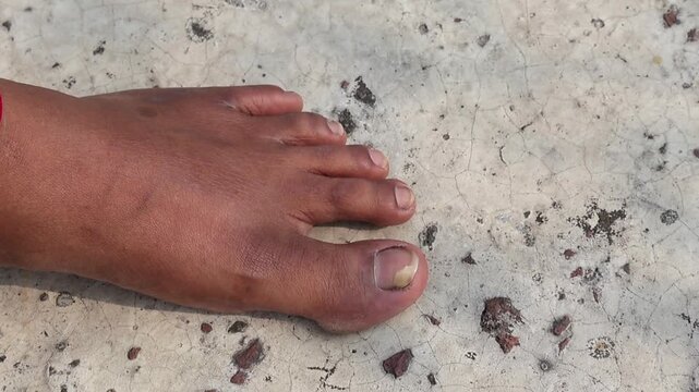 Close-up of a person's foot showing a yellowed and thickened toenail on a cracked concrete surface. This scene represents common fungal nail infections, podiatry issues, and skin health conditions.