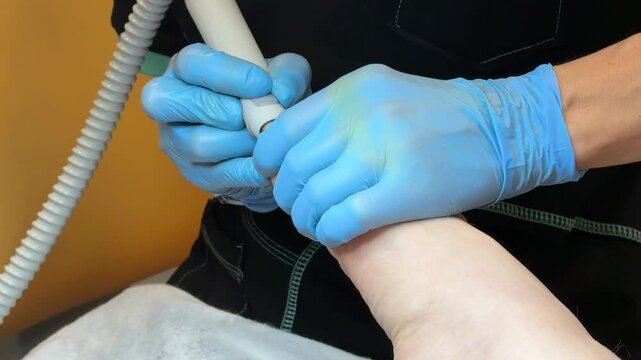Podiatrist treating toenail fungus on Caucasian foot using diamond drill and protective gloves in clinical chair setting, close-up