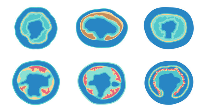 Cross-section of artery showing atherosclerosis progression, plaque buildup, and inflammation