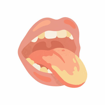 Open human mouth with white coated tongue oral thrush illustration