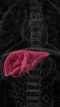 Biliary atresia is a rare condition in infants where bile ducts are blocked or absent, leading to bile buildup, liver damage, and progressive liver disease