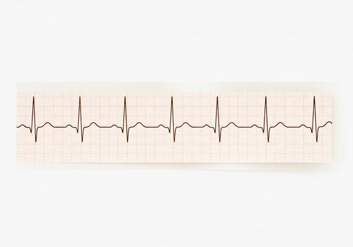 Standard ecg heart rhythm strip showing normal sinus rhythm