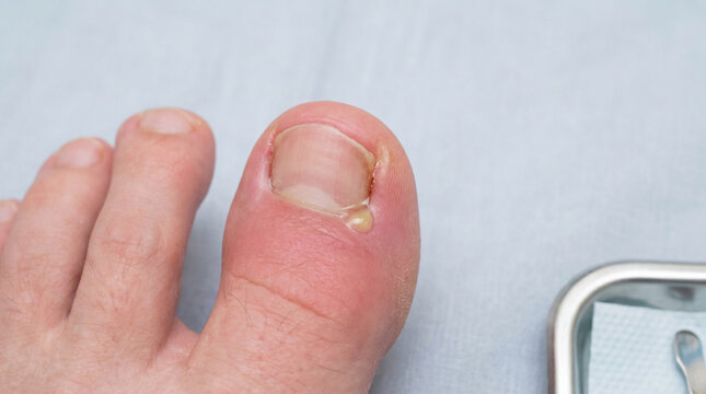 Close-up of an infected ingrown toenail on a big toe, showing redness and pus. Represents podiatry and foot health