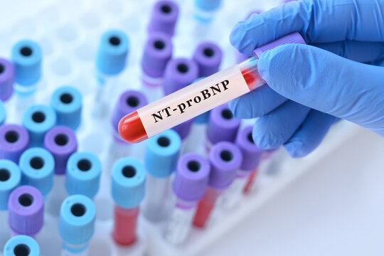 Doctor holding blood sample tube with NT pro BNP test in modern laboratory, cardiac blood analysis for heart failure diagnosis, cardiovascular risk assessment and professional medical diagnostics