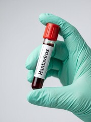 Fototapeta premium Hantavirus Blood Sample Test in Laboratory – Healthcare and Virus Detection shots.