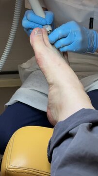 Close-up foot pedicure salon, master uses diamond drill on male foot wearing blue gloves, callus removal around heel and toes