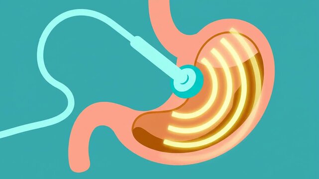 2D Flat Design Animation Of An Endoscopic Ultrasound (EUS) Procedure For Gastro-Intestinal Examination