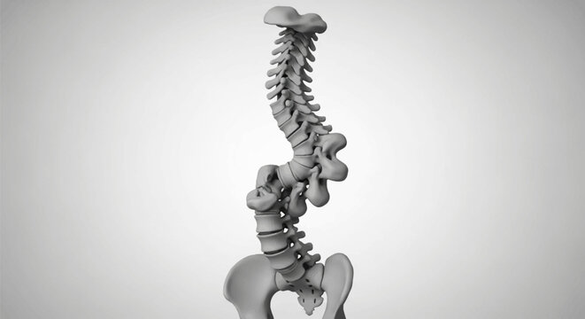 3D medical illustration of a human spine with severe scoliosis deformity showing abnormal lateral curvature of the vertebrae from the cervical to lumbar regions and pelvis.