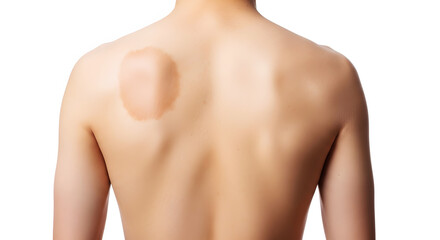 Naklejka premium Back of person with birthmark on shoulder isolated on white background skin mole