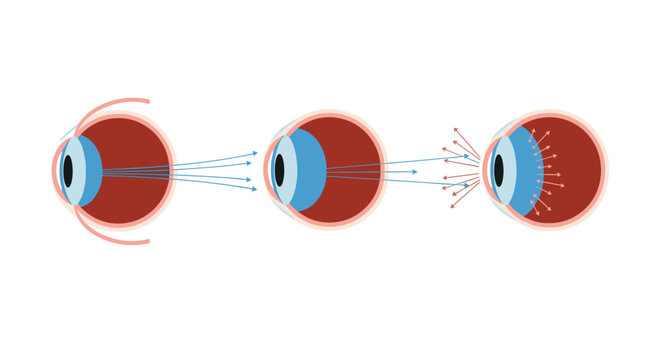 Diagram showing common eye vision conditions like nearsightedness and farsightedness with light ray focus paths.