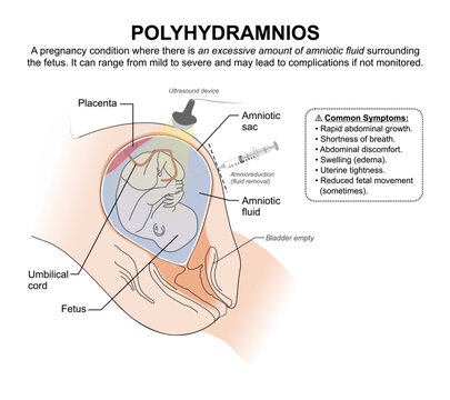 Polyhydramnios, excess amniotic fluid flashcard illustrationa