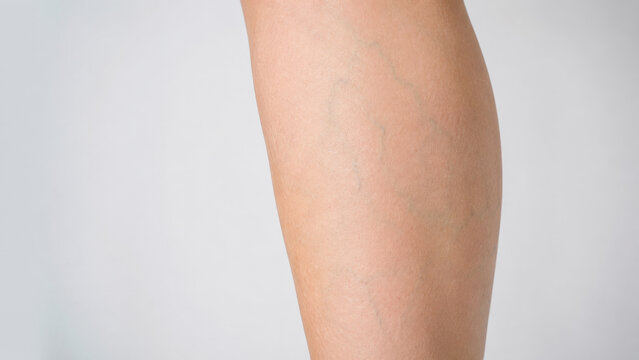 Photorealistic Lower Limb Skin with Subtle Natural Subdermal Branching Veins, Bluish Green Superficial Venous Pattern, Clinical Dermatology Close Up, Medical Teaching Image