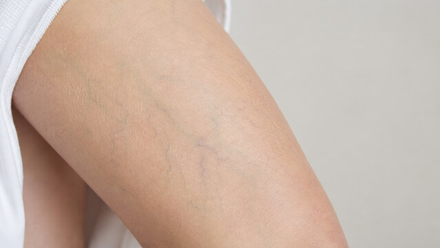 Photorealistic Lower Limb Skin with Subtle Natural Subdermal Branching Veins, Bluish Green Superficial Venous Pattern, Clinical Dermatology Close Up, Medical Teaching Image