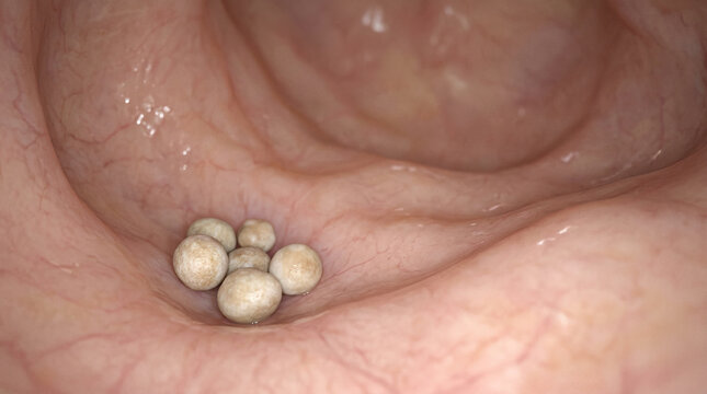 Bladder stones vesical calculi endoscopy urology surgery, medical endoscopic view showing bladder stones vesical calculi during cystoscopy with moist mucosa texture for urology diagnosis