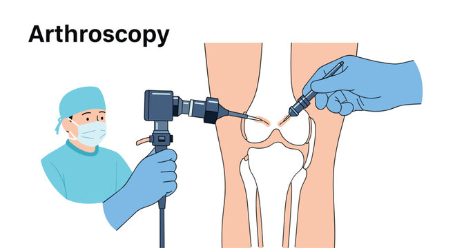 Knee arthroscopy surgery illustration showing a surgeon using tools for minimally invasive repair of joint injuries and cartilage.