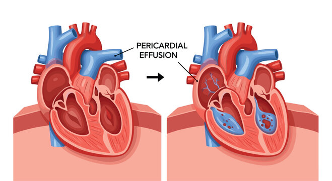 Comparative medical diagram of a healthy heart and one affected by pericardial effusion, showing fluid buildup in the pericardial sac area.