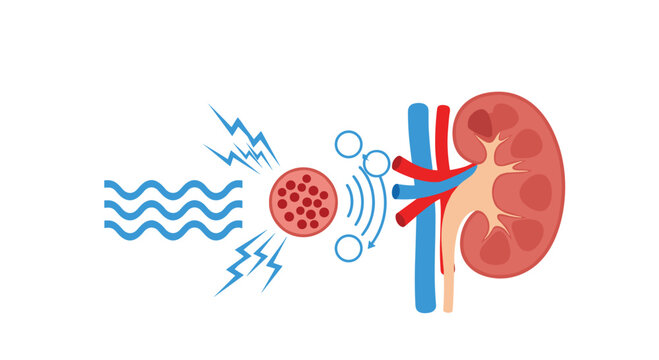 Infographic explaining the lithotripsy process where shock waves are used to break down a kidney stone into smaller pieces for easier passage.