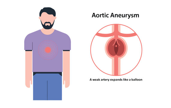 Aortic aneurysm illustration and diagram
