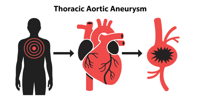 Thoracic aortic aneurysm illustration progression and anatomical detail