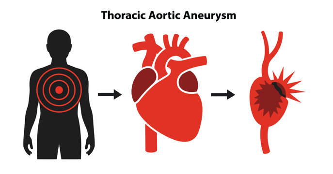 Thoracic aortic aneurysm medical illustration