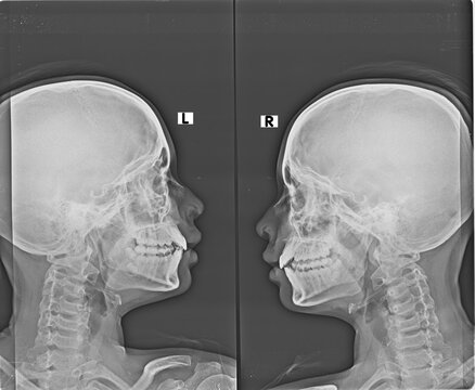 Lateral cephalometric X-ray of a human skull showing the profile view of teeth and jaw alignment. This medical radiograph displays both left and right side orientations for orthodontic diagnostic
