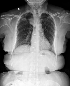 Post-Operative Chest X-ray with Sternal Wires and Surgical Staples