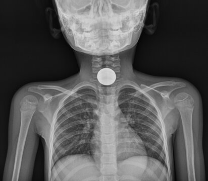 Pediatric chest and abdominal X-ray showing a foreign body coin lodged in the upper esophagus.