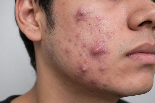 Severe Cystic Acne and Acne Scars on Male Facial Skin