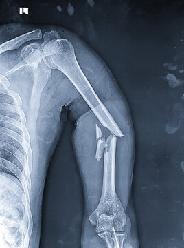Diagnostic radiograph displaying a displaced, comminuted mid-shaft fracture of the left humerus.