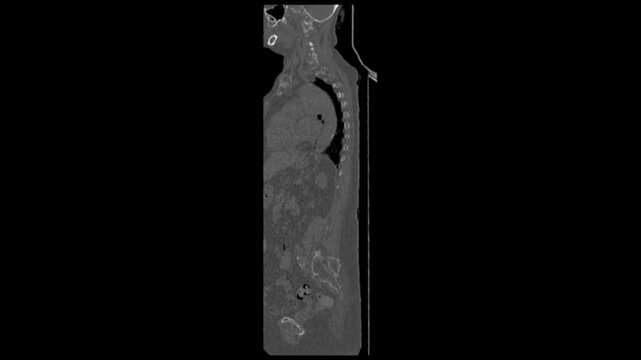 Lumbar Spine CT Scan Footage for Neurosurgical Evaluation and Spinal Stenosis Screening