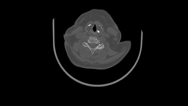 Computed Tomography Scan Video Tracking Lumbar Spine Intervertebral Alignment