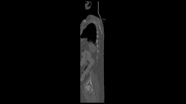 Computed Tomography Scan of Lower Back for Lumbar Disc Herniation Diagnosis