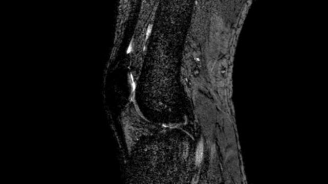Medical Imaging of Knee Joint Scan for Ligament and Meniscus Injury Assessment
