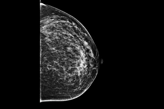 Medical themes: Mammography showing coarse calcifications belonging to a fibroadenoma.