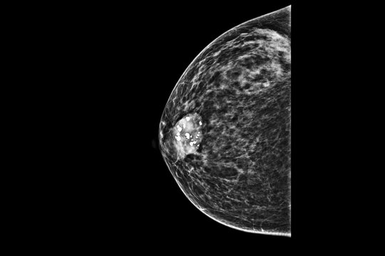 Medical themes: Mammography showing coarse calcifications belonging to a fibroadenoma.