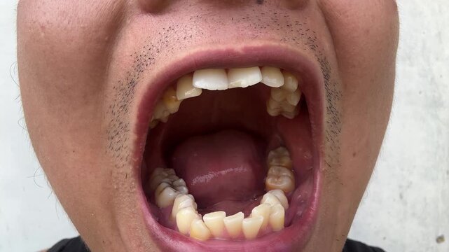 Close Up of Man Showing Teeth and Tongue for Dental Examination