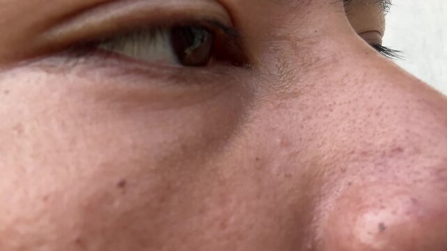 Close up of man with enlarged pores and oily skin on nose