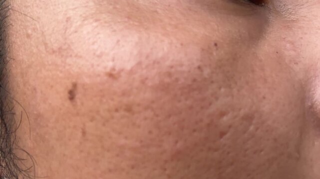 Macro video of human facial skin with acne scars and enlarged pores