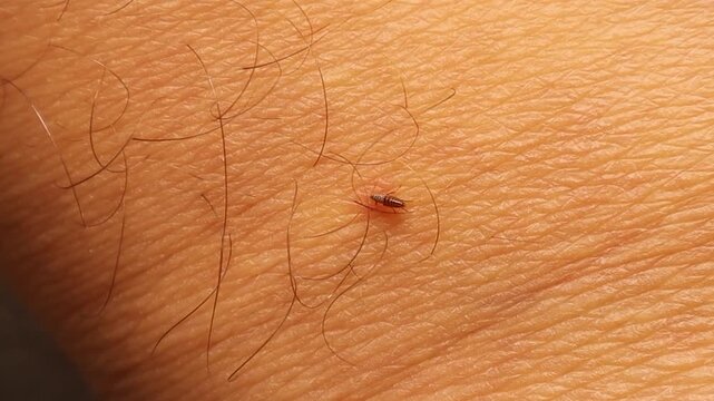 Flea sucking human blood in extreme macro on skin. Disease vector, parasite infestation, infection risk, dermatology, pest control, healthcare, hygiene, medical and biology concept.