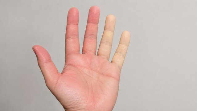 Photorealistic hand mild digital perfusion gradient, pale cool-toned fingertips, reduced distal circulation, natural skin texture, medical teaching close-up
