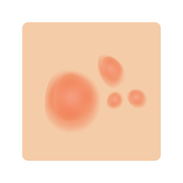 Inflammatory Acne on skin illustration cartoon cute