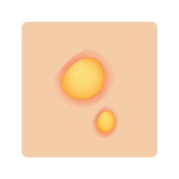 Acne Pustules on skin illustration cartoon cute