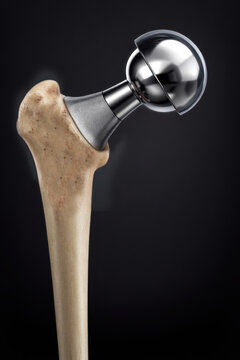 Hip prosthesis implanted in proximal femur, showing hemiarthroplasty with metallic femoral head and stem, anatomical bone structure with cortical and cancellous layers, generative ai illustration