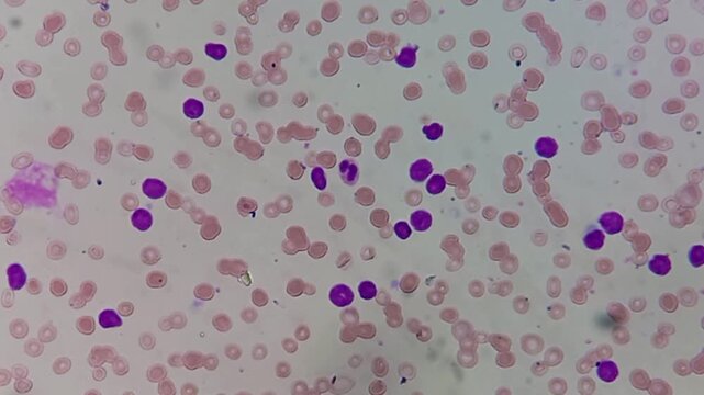 Feature suggestive of acute lymphoblastic leukemia. Atypical looking mononuclear cell with scanty cytoplasm and inconspicuous nucleoli.