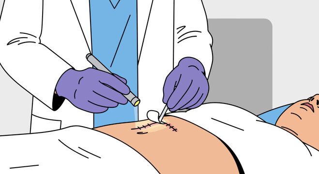 Surgeon performing laparoscopic surgery on patient's abdomen with surgical instruments